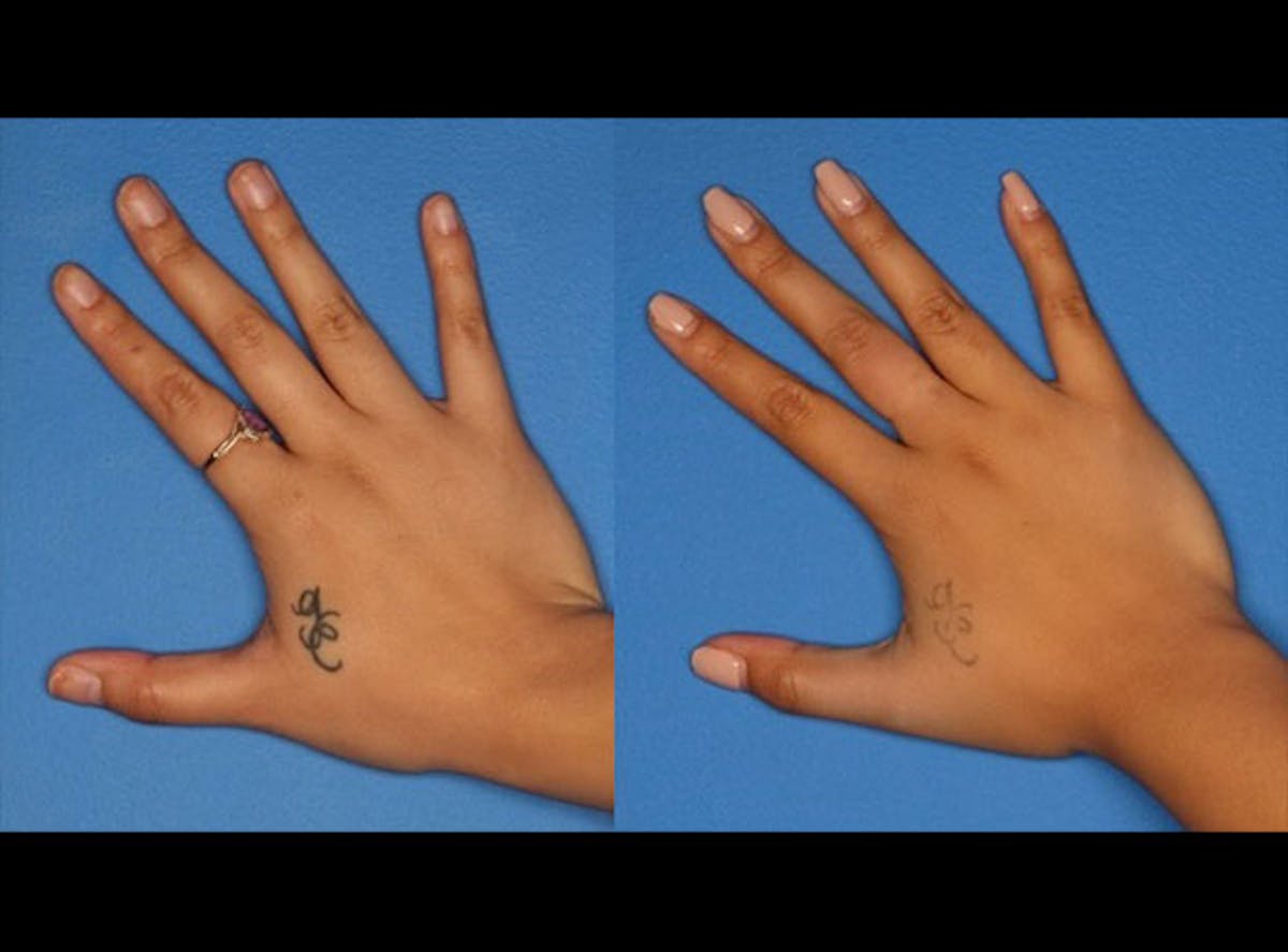 Laser Tattoo Removal Before & After Gallery - Patient 24560575 - Image 1