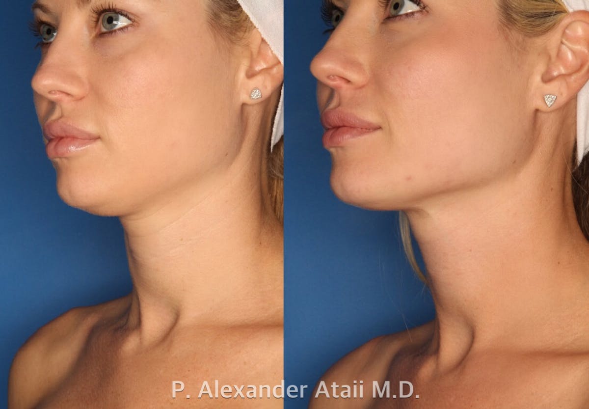 Ultherapy Before & After Gallery - Patient 24560689 - Image 1