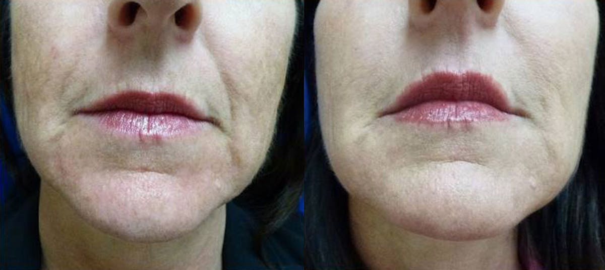 Dermal Fillers Before & After Gallery - Patient 168327 - Image 1