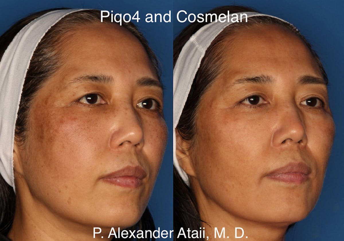 Cosmelan Peel Before & After Gallery - Patient 24560939 - Image 1
