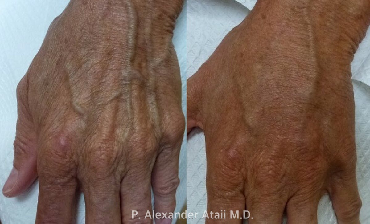 Hand Rejuvenation Before & After Gallery - Patient 24560945 - Image 1