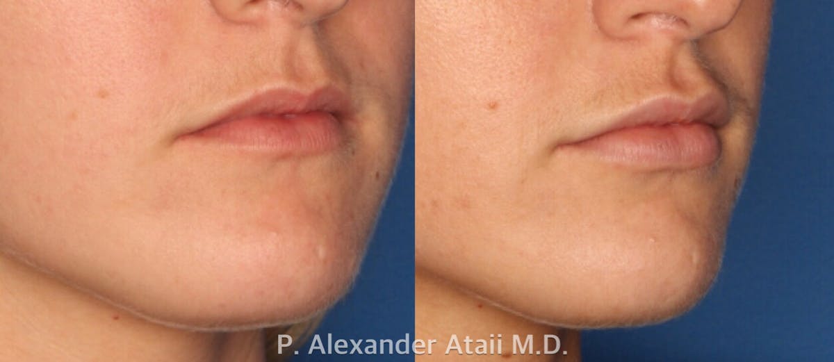 Lip Augmentation Before & After Gallery - Patient 24560968 - Image 1