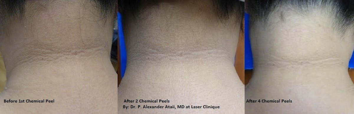 Medical Grade Chemical Peels Before & After Gallery - Patient 24560966 - Image 1