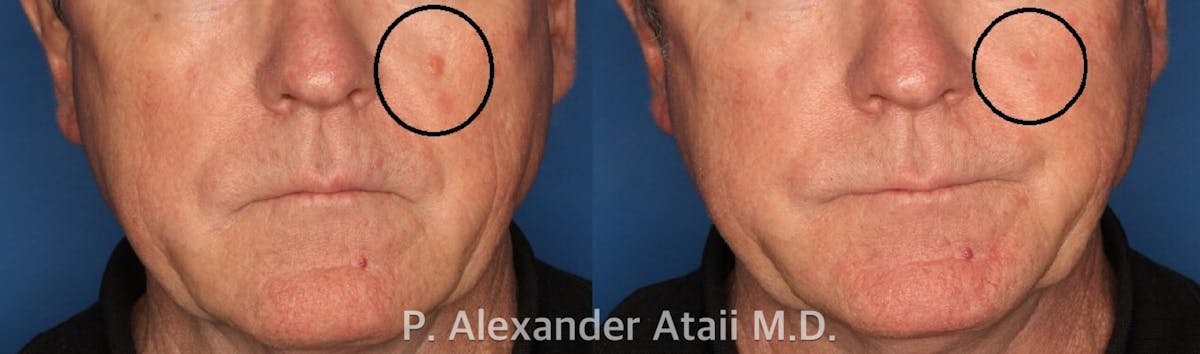 Mole Removal Before & After Gallery - Patient 24560978 - Image 1