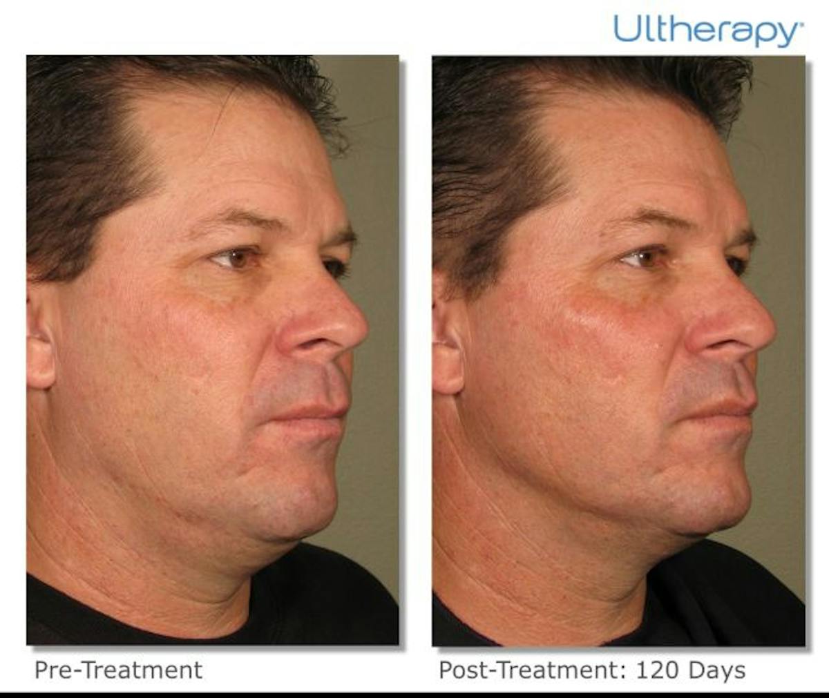 Ultherapy Before & After Gallery - Patient 36623113 - Image 1