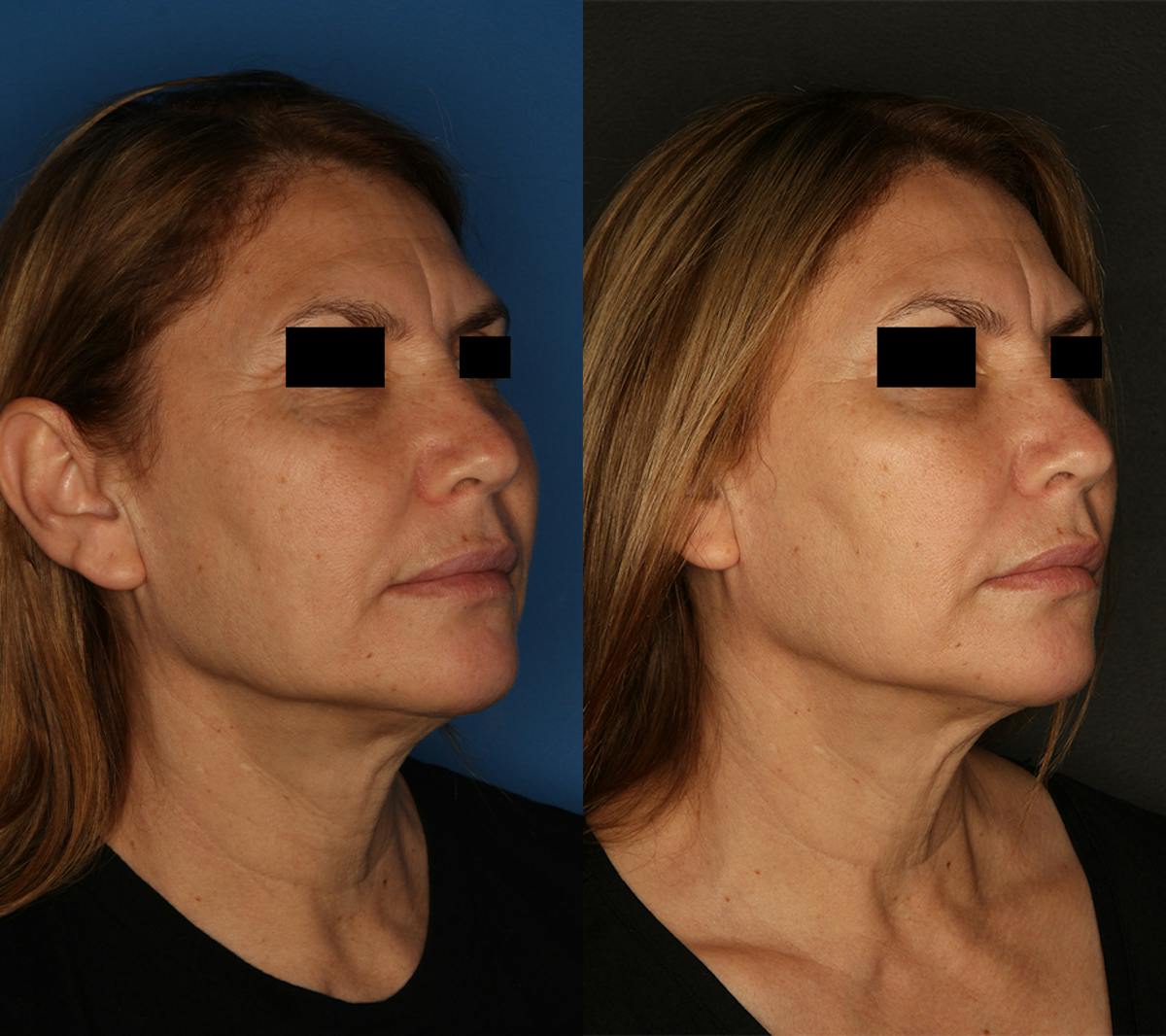 Morpheus8 Before & After Gallery - Patient 64000756 - Image 1