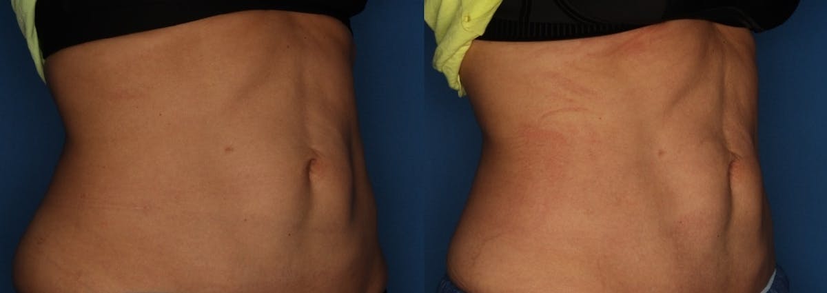 TruFlex Before & After Gallery - Patient 140401010 - Image 1