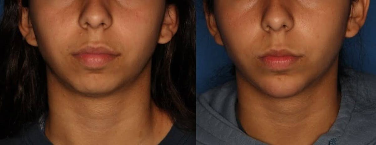Dermal Fillers Before & After Gallery - Patient 284387 - Image 1