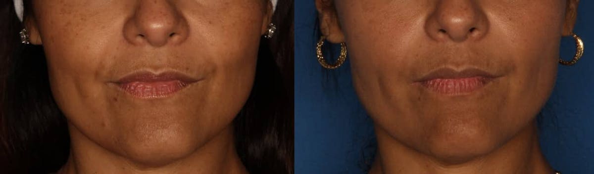 Dermal Fillers Before & After Gallery - Patient 103238 - Image 1