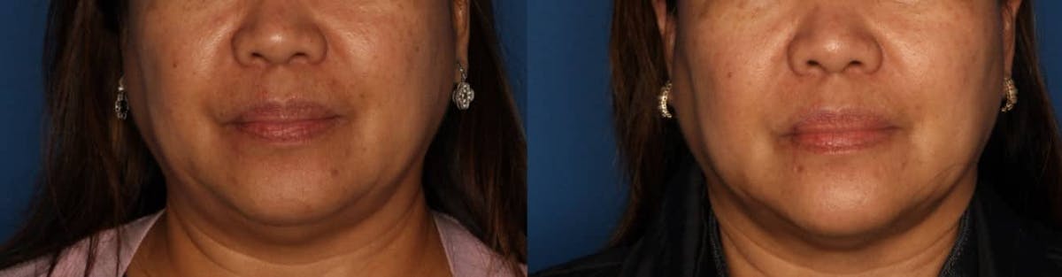 Dermal Fillers Before & After Gallery - Patient 864862 - Image 1