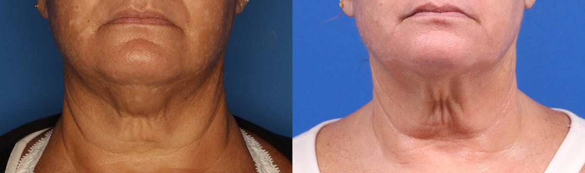 Kybella Before & After Gallery - Patient 905340 - Image 1