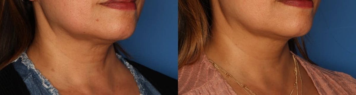 Kybella Before & After Gallery - Patient 174380 - Image 1