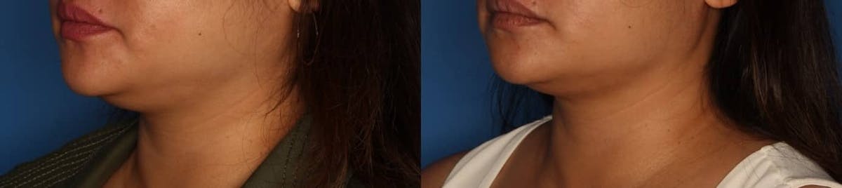 Kybella Before & After Gallery - Patient 287827 - Image 1